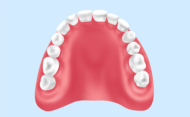 レジン床義歯