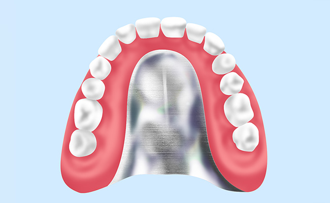 金属床義歯　【自費診療】
