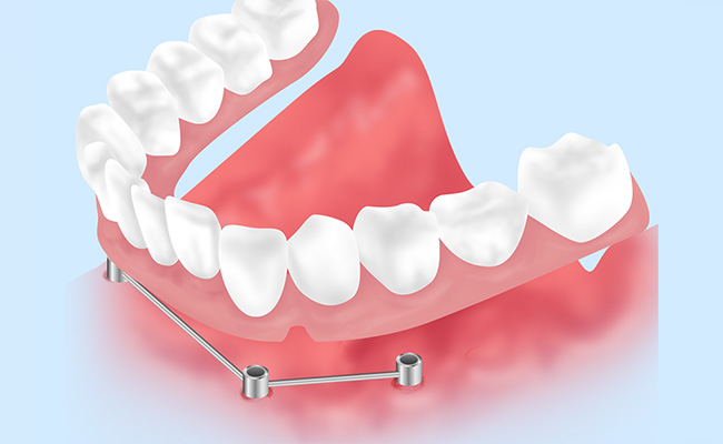 インプラント支持義歯　【自費診療】