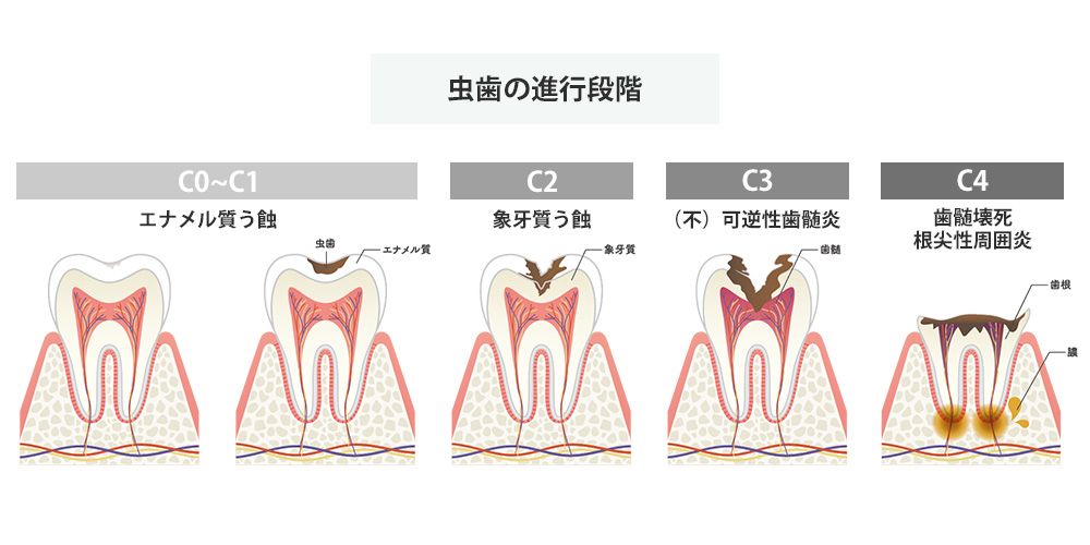 世界基準の評価法「ICDAS」で、なるべく削らない虫歯治療を