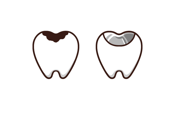 １、	治療した歯（詰め物被せ物）はどうして虫歯になるの？