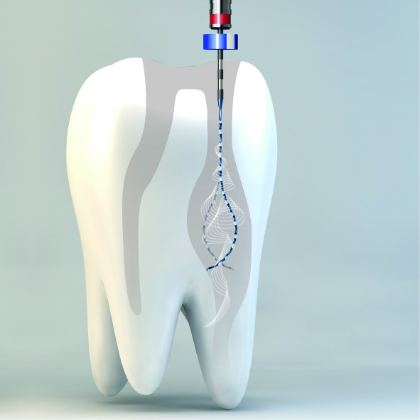 3.残存歯質の確認　4.根管の感染除去、洗浄