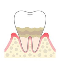 ◎第１位　歯周病