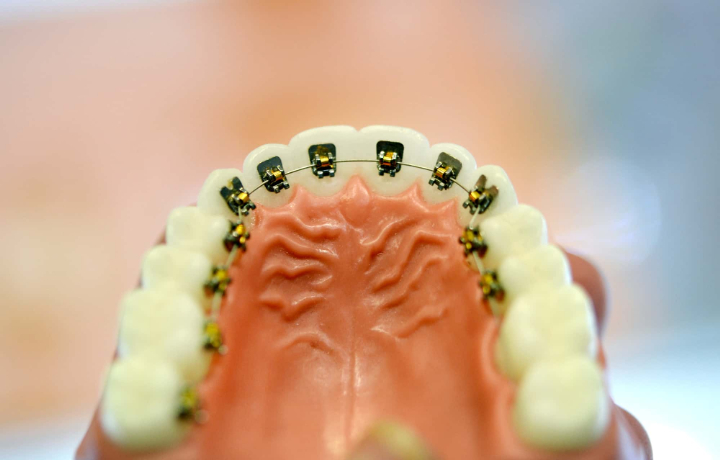 裏側矯正とは？メリットやデメリット、費用についても解説