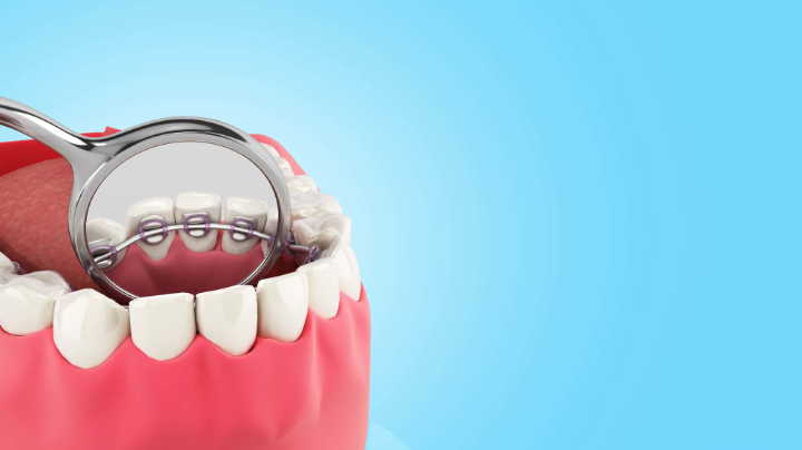 裏側矯正について説明するイメージ