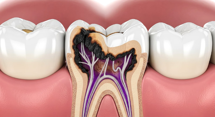 虫歯になった奥歯の模型