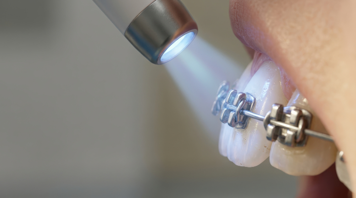 ワイヤー矯正で出っ歯は治る？メリット・デメリットや費用も