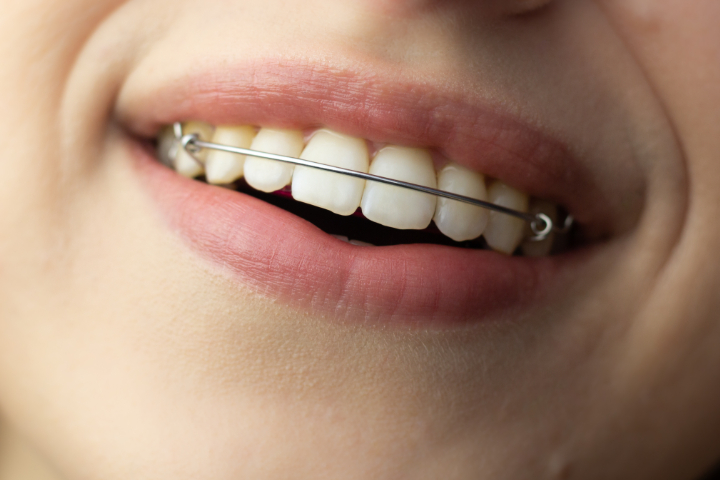 マウスピース矯正後に使うリテーナーって何？種類や装着期間も