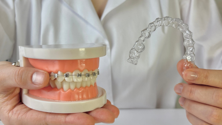ワイヤー矯正をした歯の模型とマウスピースを手に八重歯の矯正方法を説明するイメージ