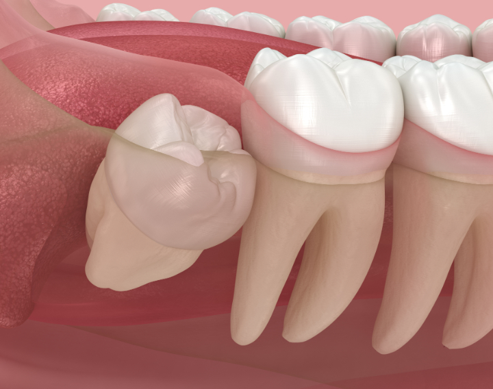 親知らずのイメージ