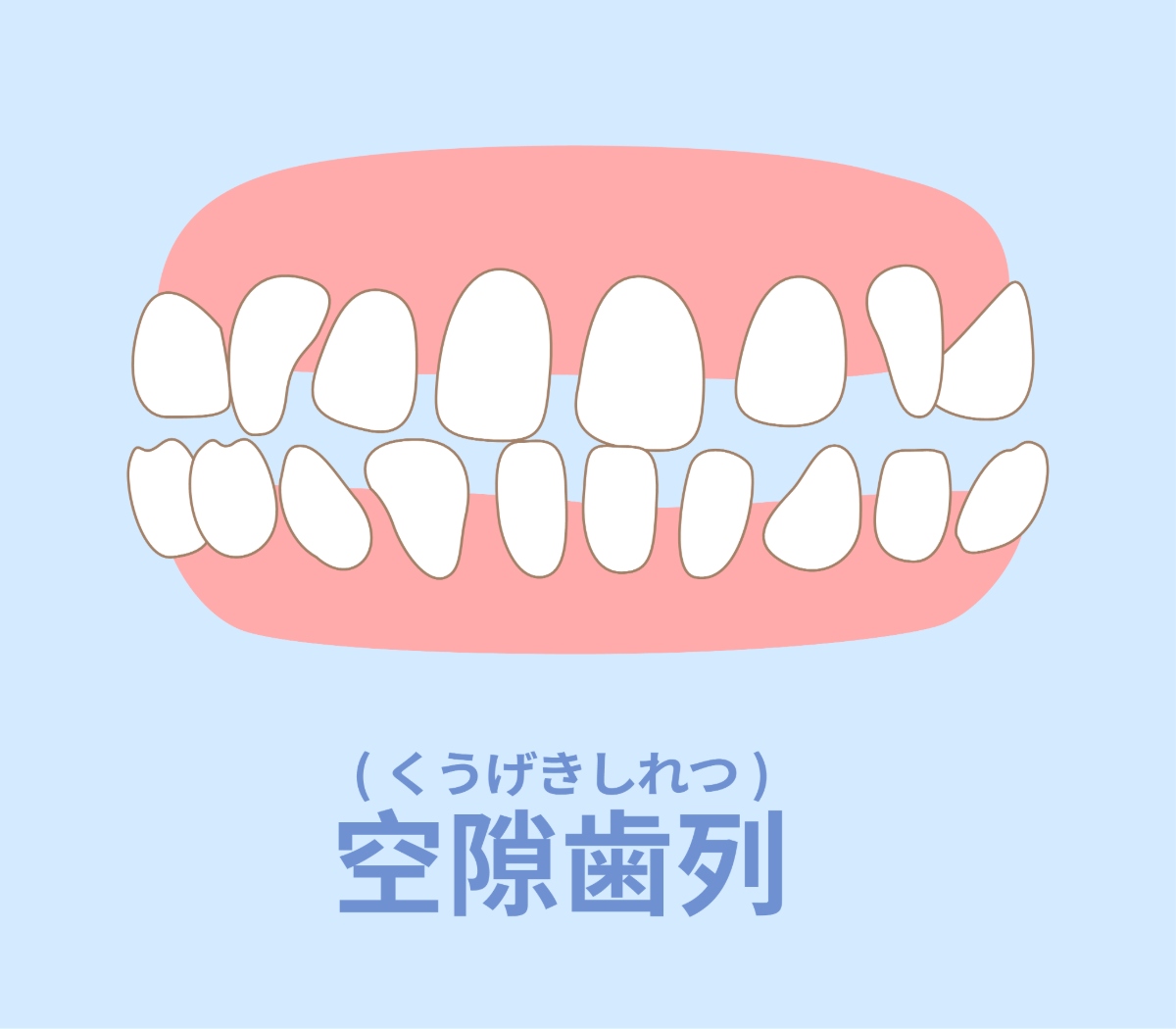 すきっ歯の構造